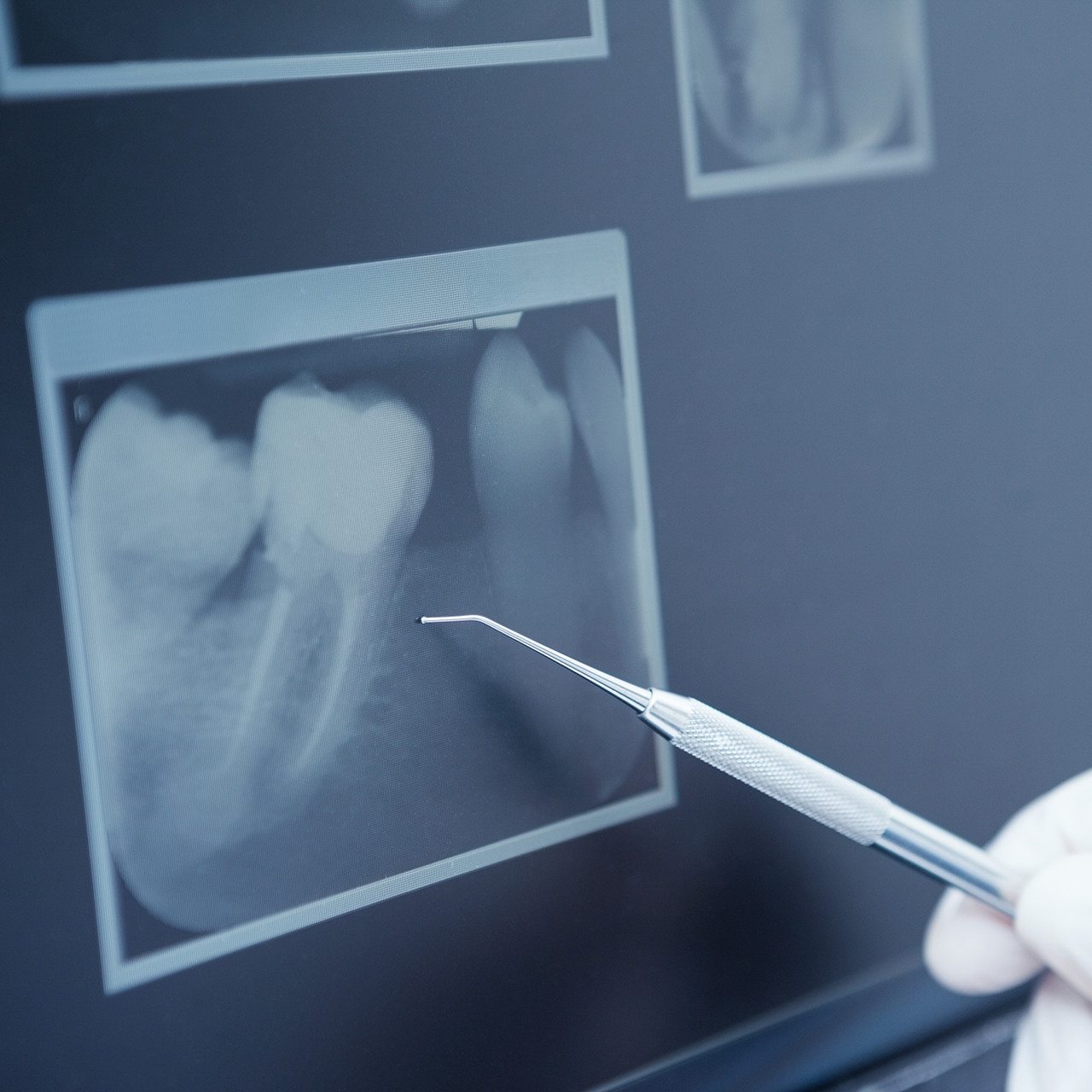 endodontics service image Dentistry of the Carolinas