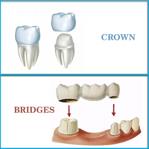 Restoring Beautiful Smiles with Crowns and Bridges at DOC