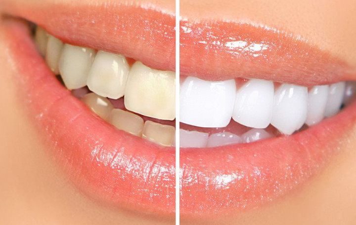 Have You Heard? DOC is offering 50% Off In-Chair Tooth Whitening
