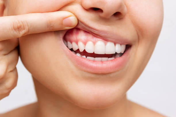 Celebrate National Gum Care Month: Your Guide to a Healthy Smile